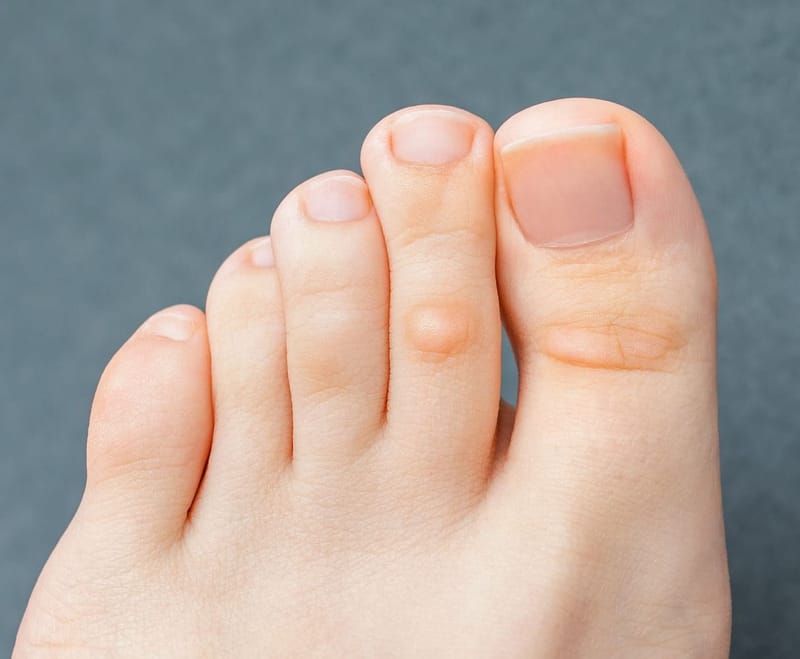 Nagelherstel behandeling