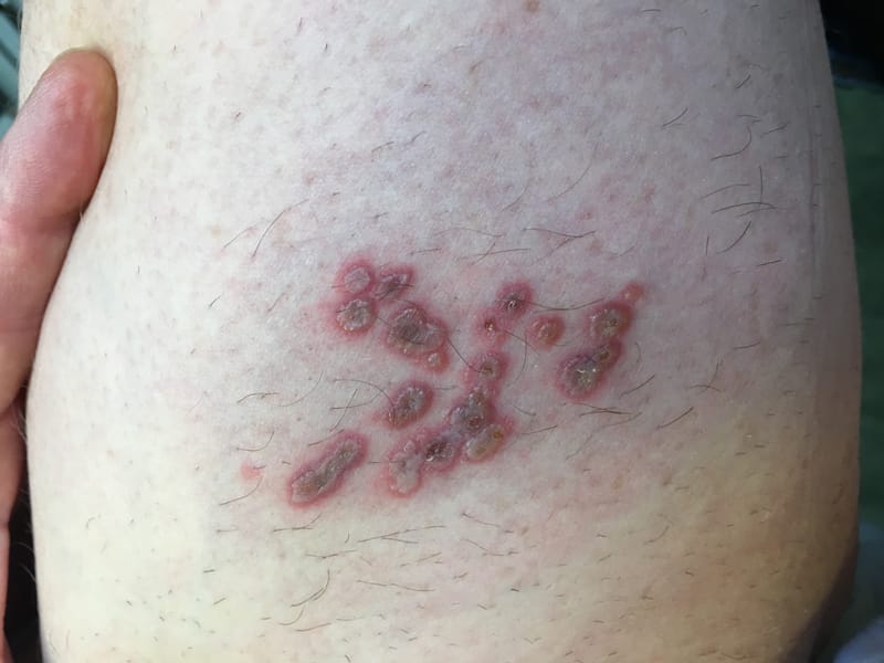 "Travel Acquired Dermatoses"