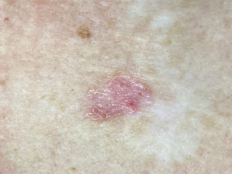 "Twenty Principles to Spot Skin Cancer"