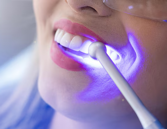 Clareamento dentário