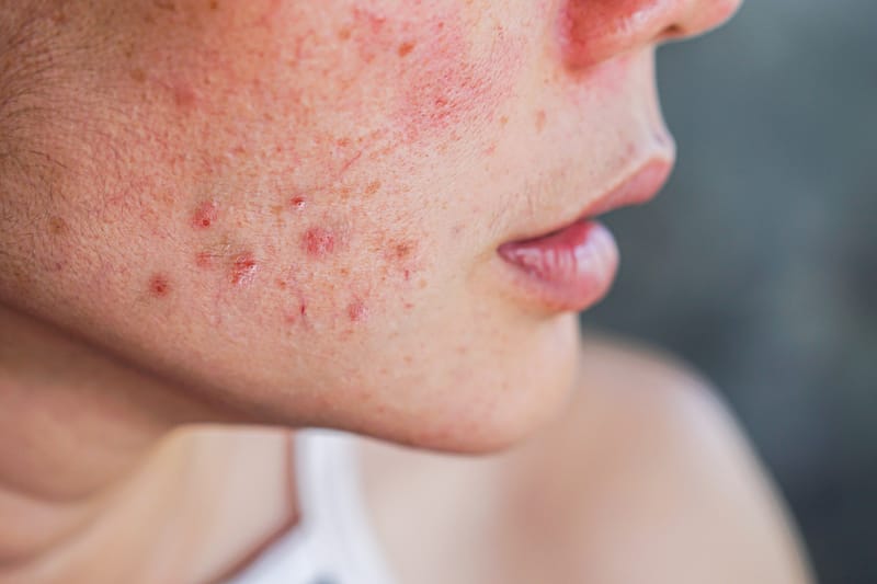 Tratamento para Acne