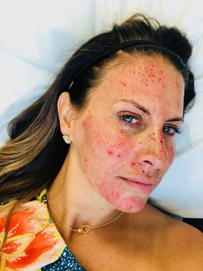 Why Celebrities Love the Vampire Facial?