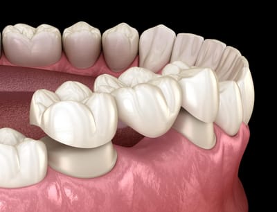 What Are Dental Crowns & Bridges Made Of?