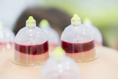 What are the sunnah points of Hijama?