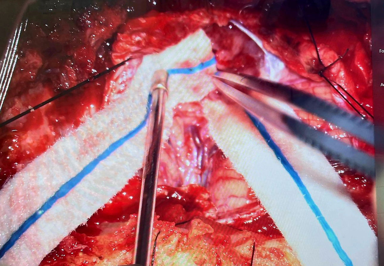 Dr. Anton Wohl is a highly experienced neurosurgeon specializing in neuro-oncology, with a clinical focus on brain tumor surgery and stereotactic radiosurgery