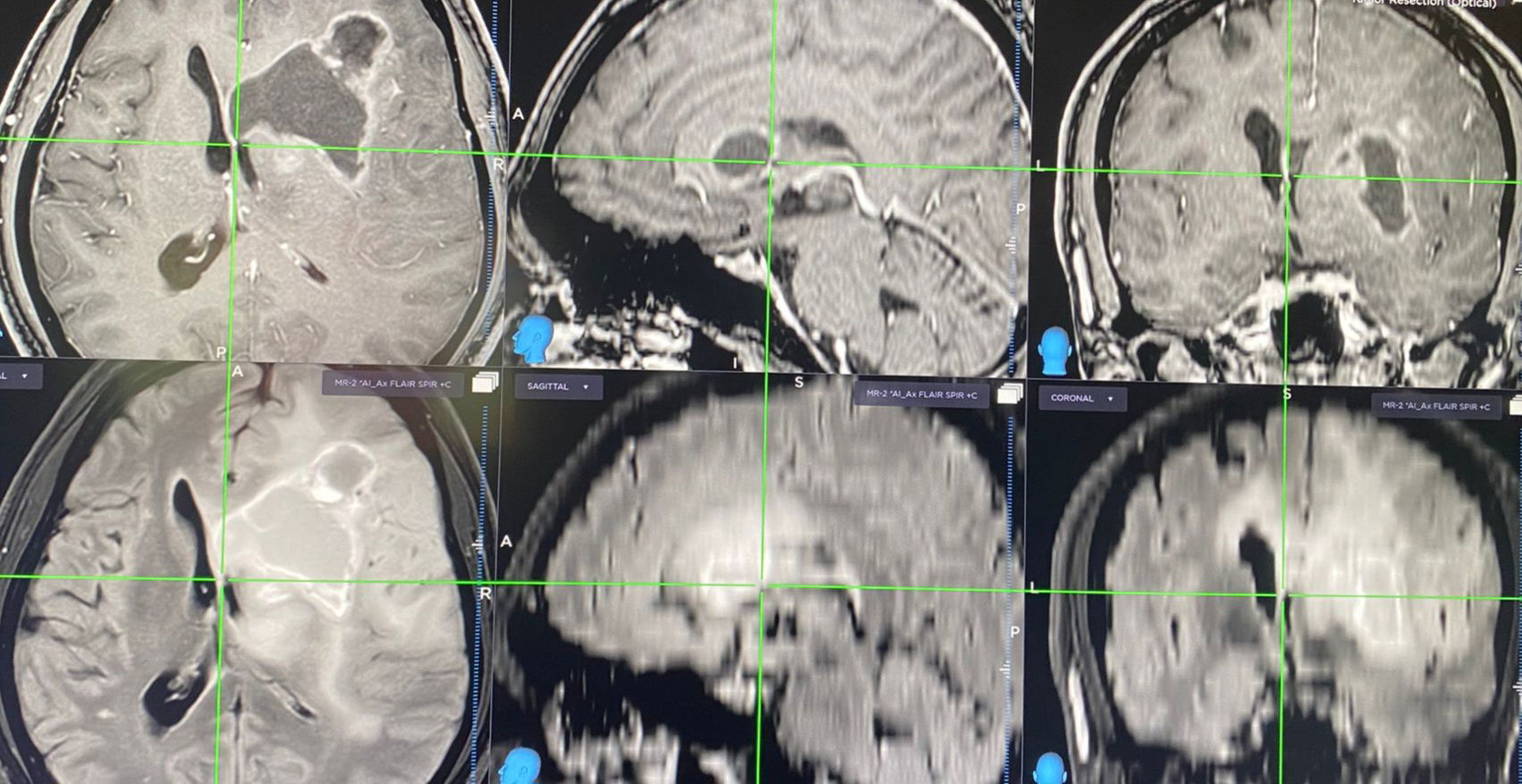 Dr. Anton Wohl is a highly experienced neurosurgeon specializing in neuro-oncology, with a clinical focus on brain tumor surgery and stereotactic radiosurgery