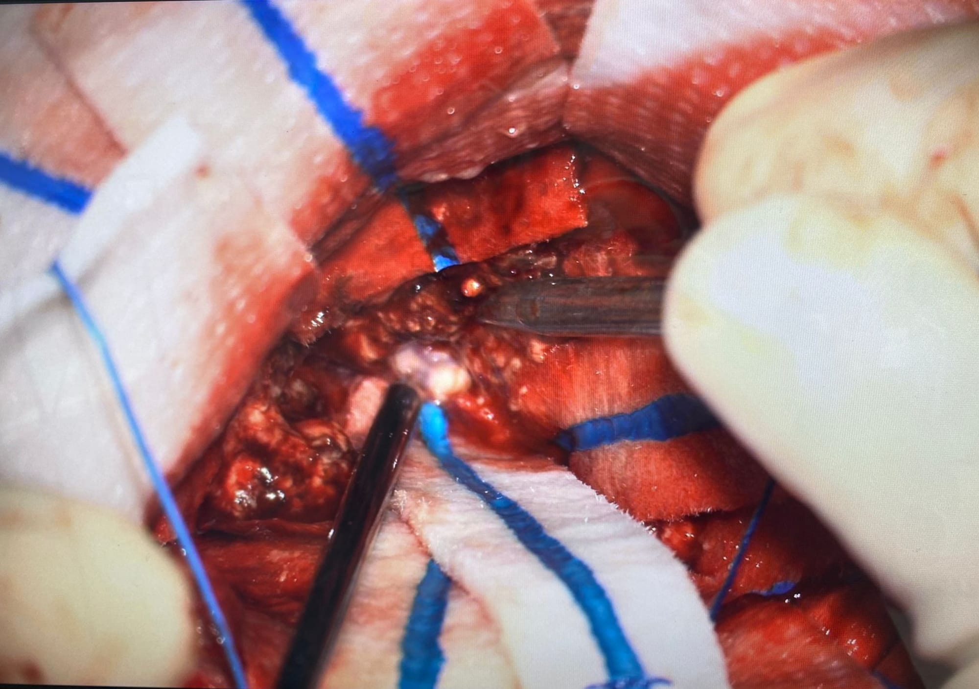 Dr. Anton Wohl is a highly experienced neurosurgeon specializing in neuro-oncology, with a clinical focus on brain tumor surgery and stereotactic radiosurgery