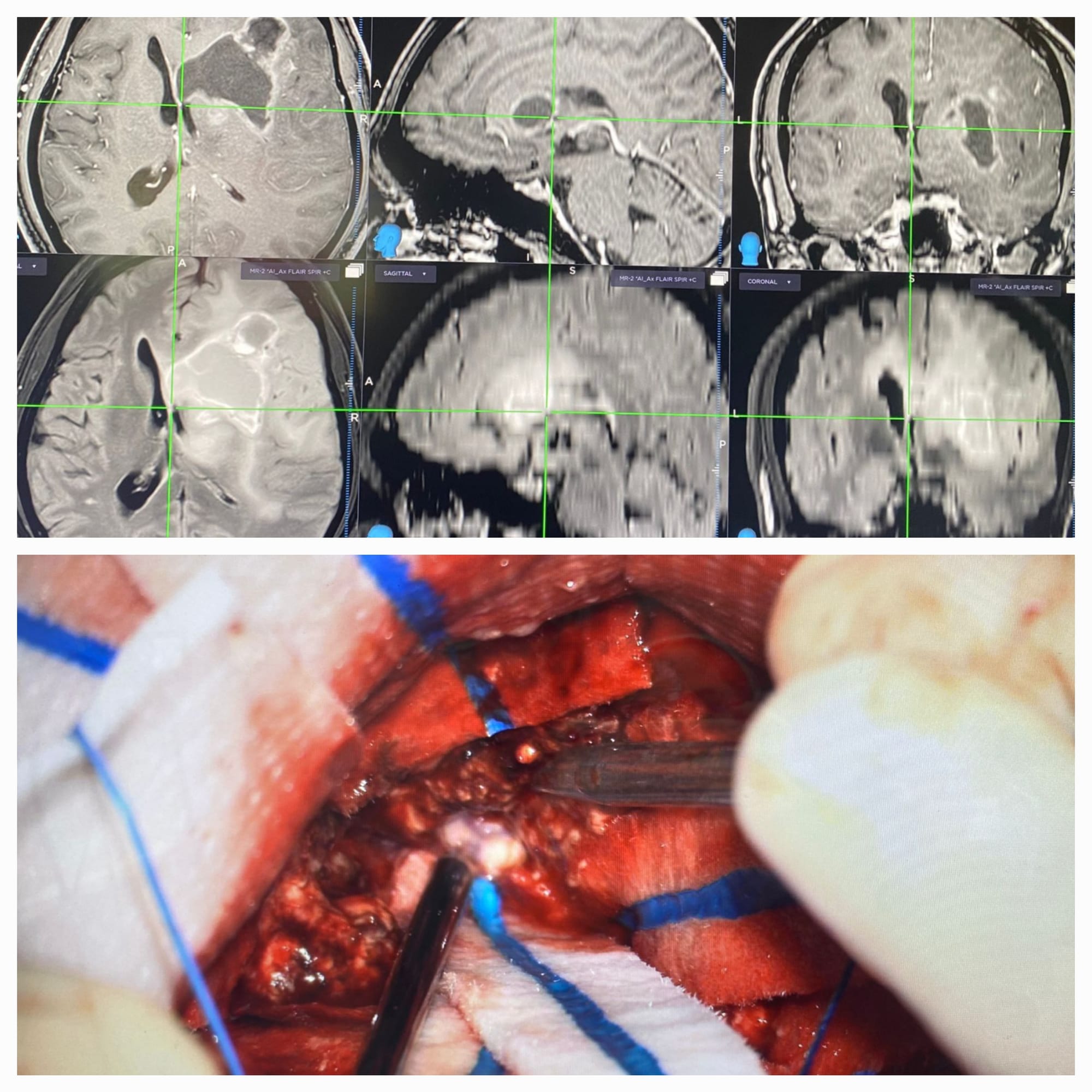 Dr. Anton Wohl is a highly experienced neurosurgeon specializing in neuro-oncology, with a clinical focus on brain tumor surgery and stereotactic radiosurgery