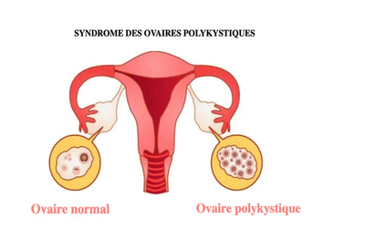Le SOPK et la Naturopathie : Comprendre et Accompagner Naturellement