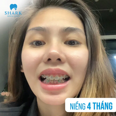 May tuoi nen nieng rang va khong nen nieng rang?