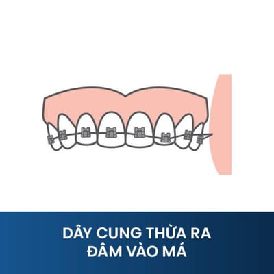Day cung nieng rang dam vao ma thi xu ly nhu the nao?
