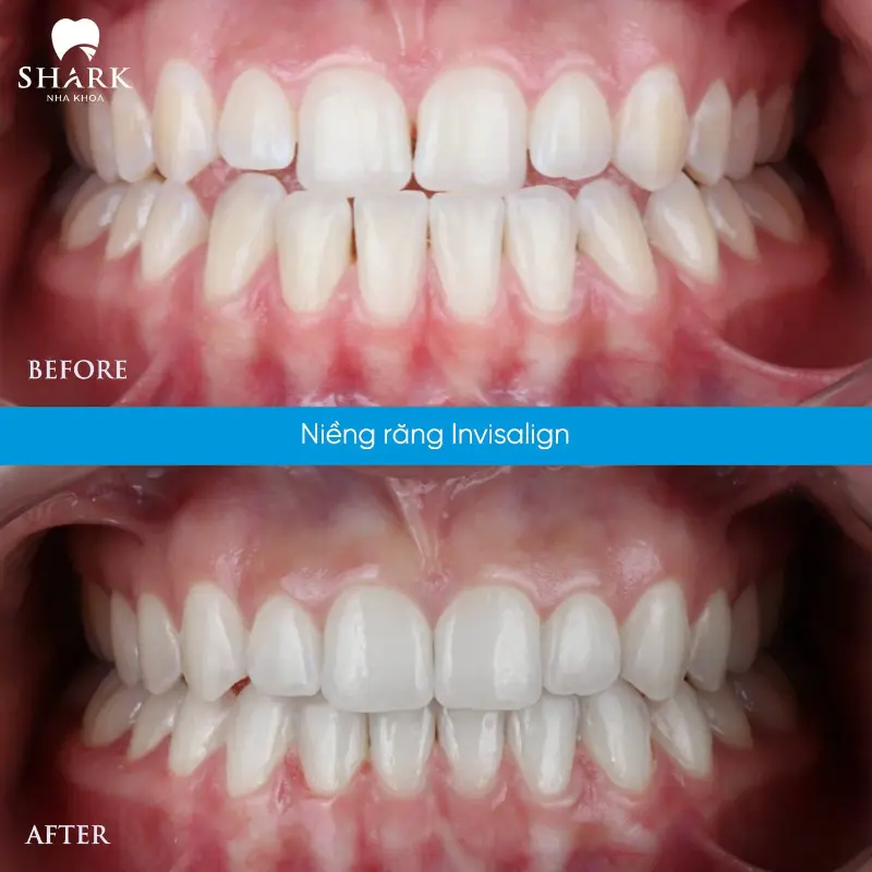 Niềng răng