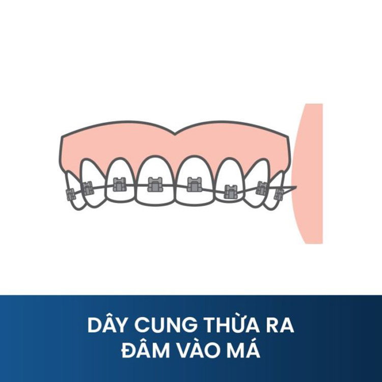 dây cung niềng răng