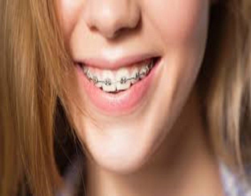 gắn vít niềng răng