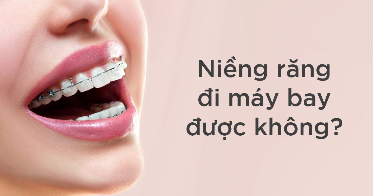Niềng răng đi máy bay