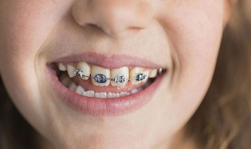 Kéo 4 cụm răng cửa