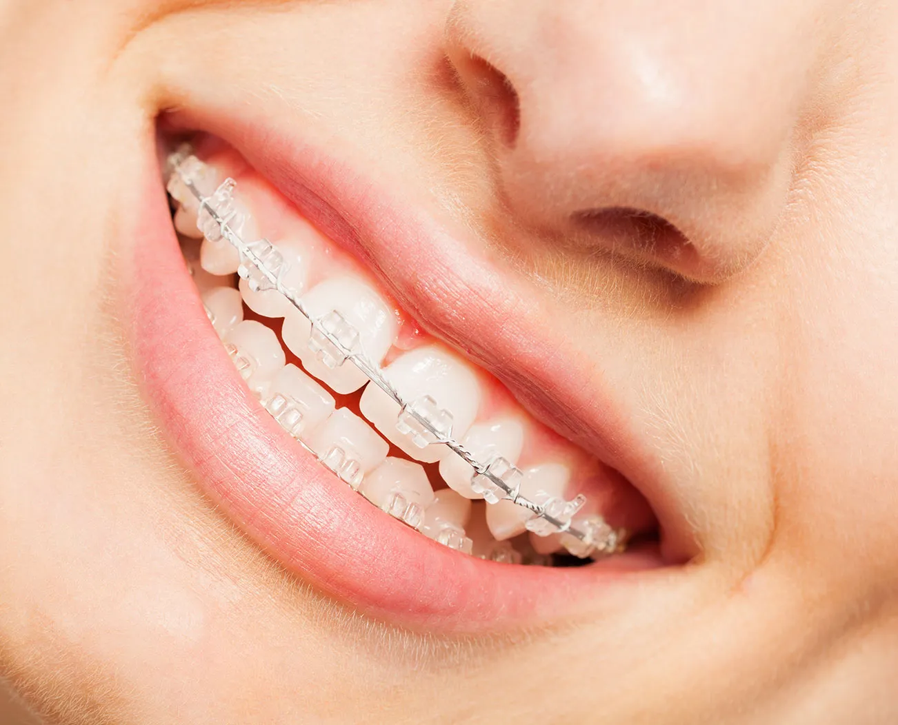 Niềng răng mắc cài sứ