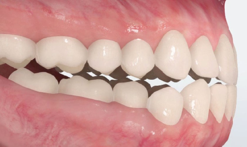 Khối cắn đối đầu