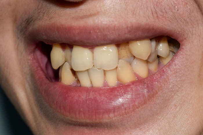 Răng mọc lộn xộn