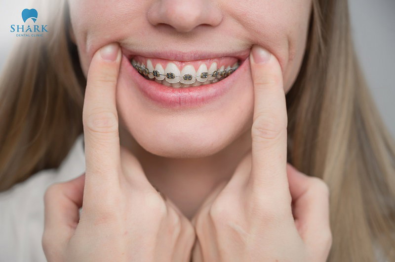 Niềng răng với giá 20 triệu đồng