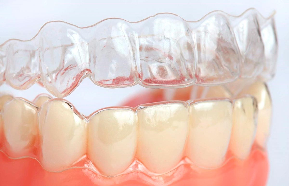 Niềng răng trong suốt