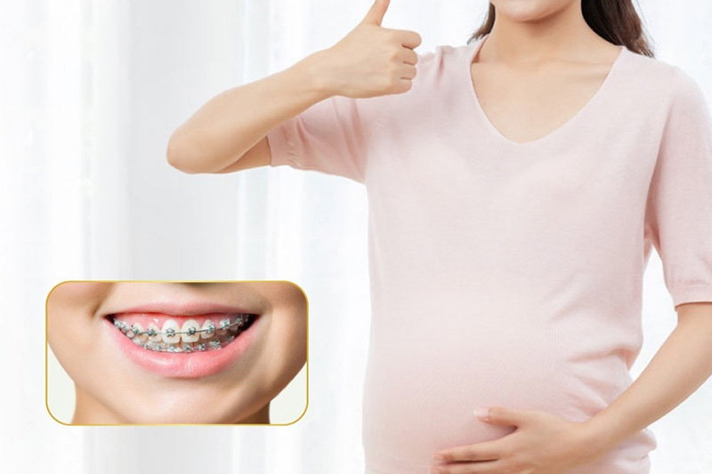 Mang thai tháng thứ mấy mới được niềng răng