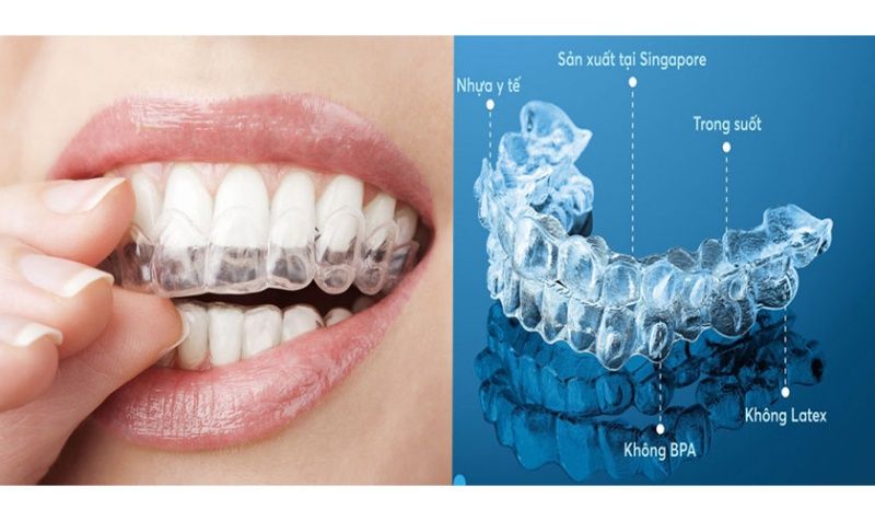 Niềng răng lòi xỉ