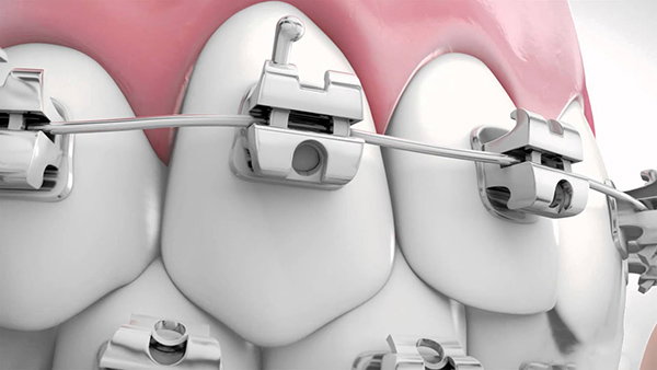 Mắc cài tự buộc