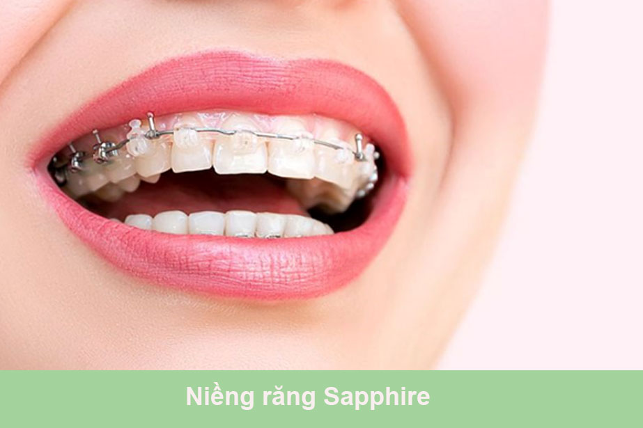 Niềng răng Sapphire