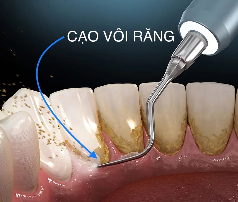 Cạo vôi răng