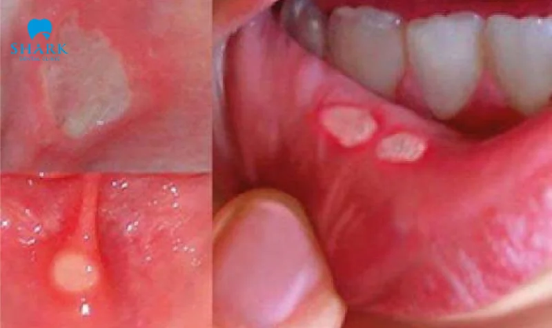 Cắn vào má gây lỡ loét