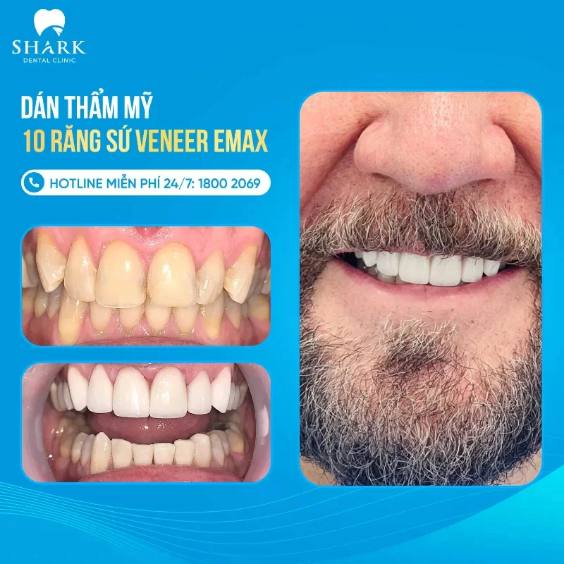 Dán sứ Emax