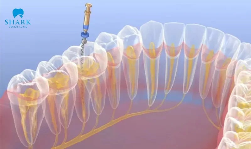 Mức độ tổn thương tủy