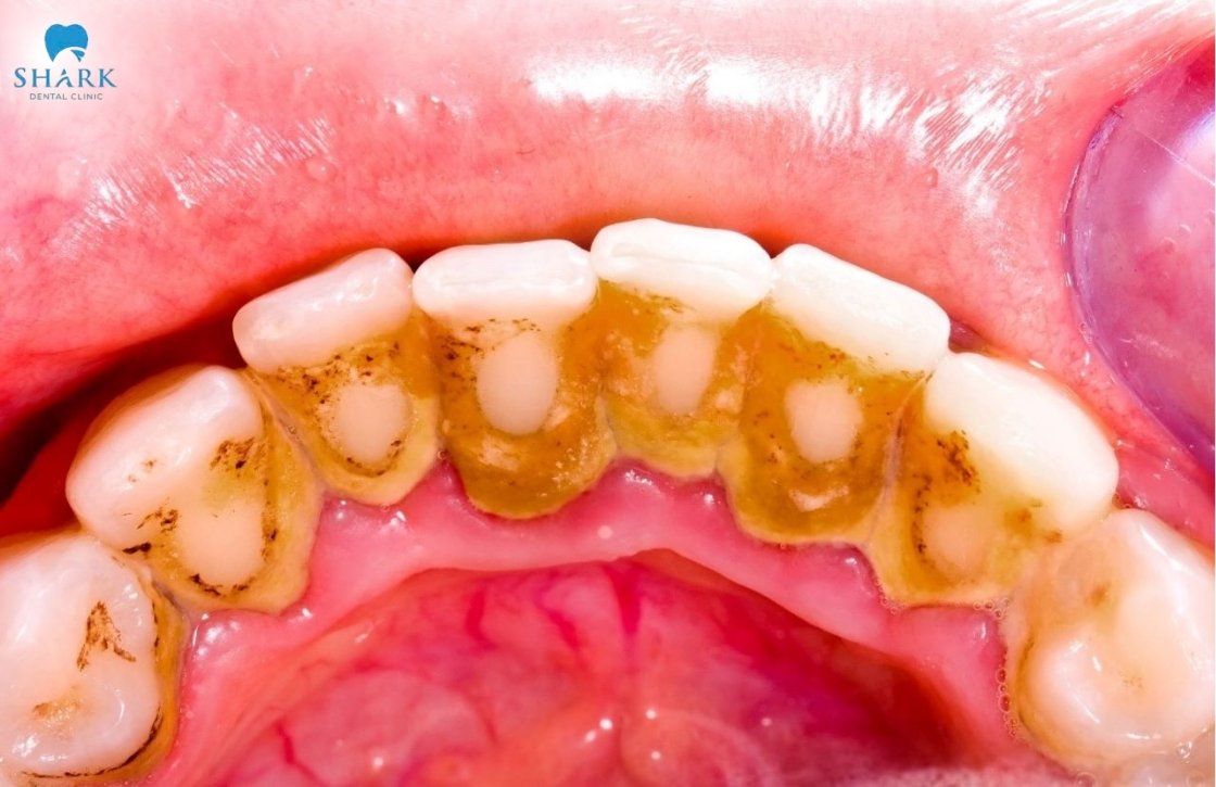 Cao răng cấp độ 4
