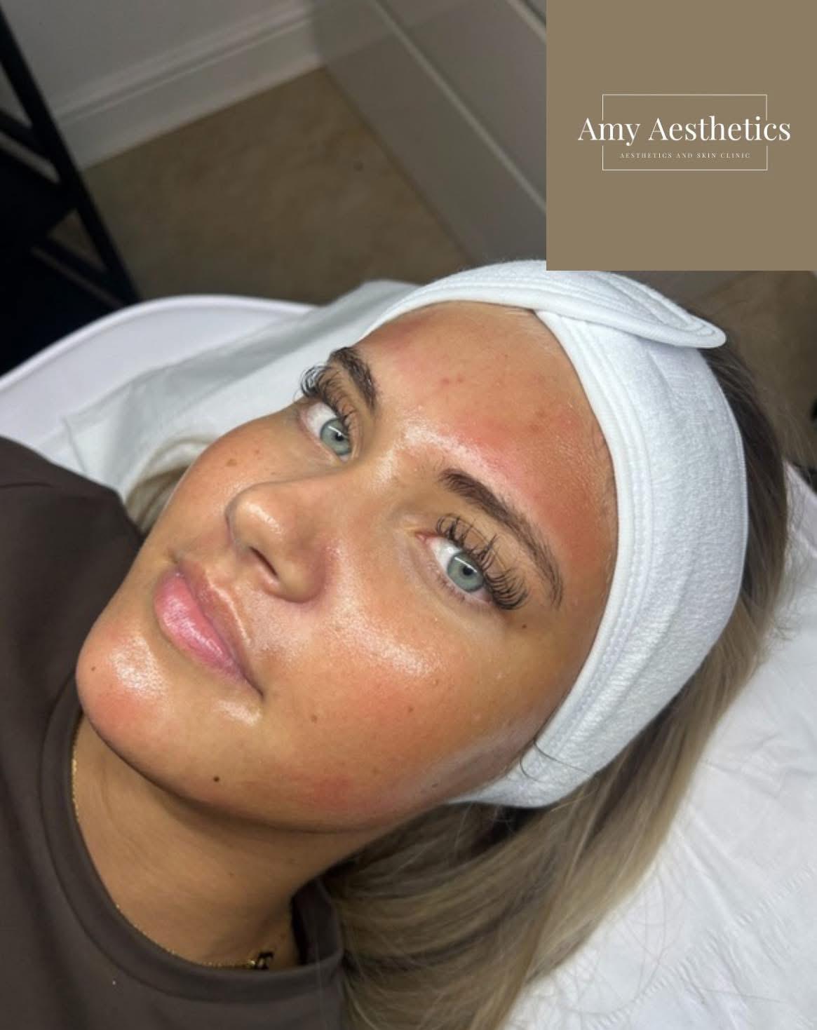Micro Needling Facial