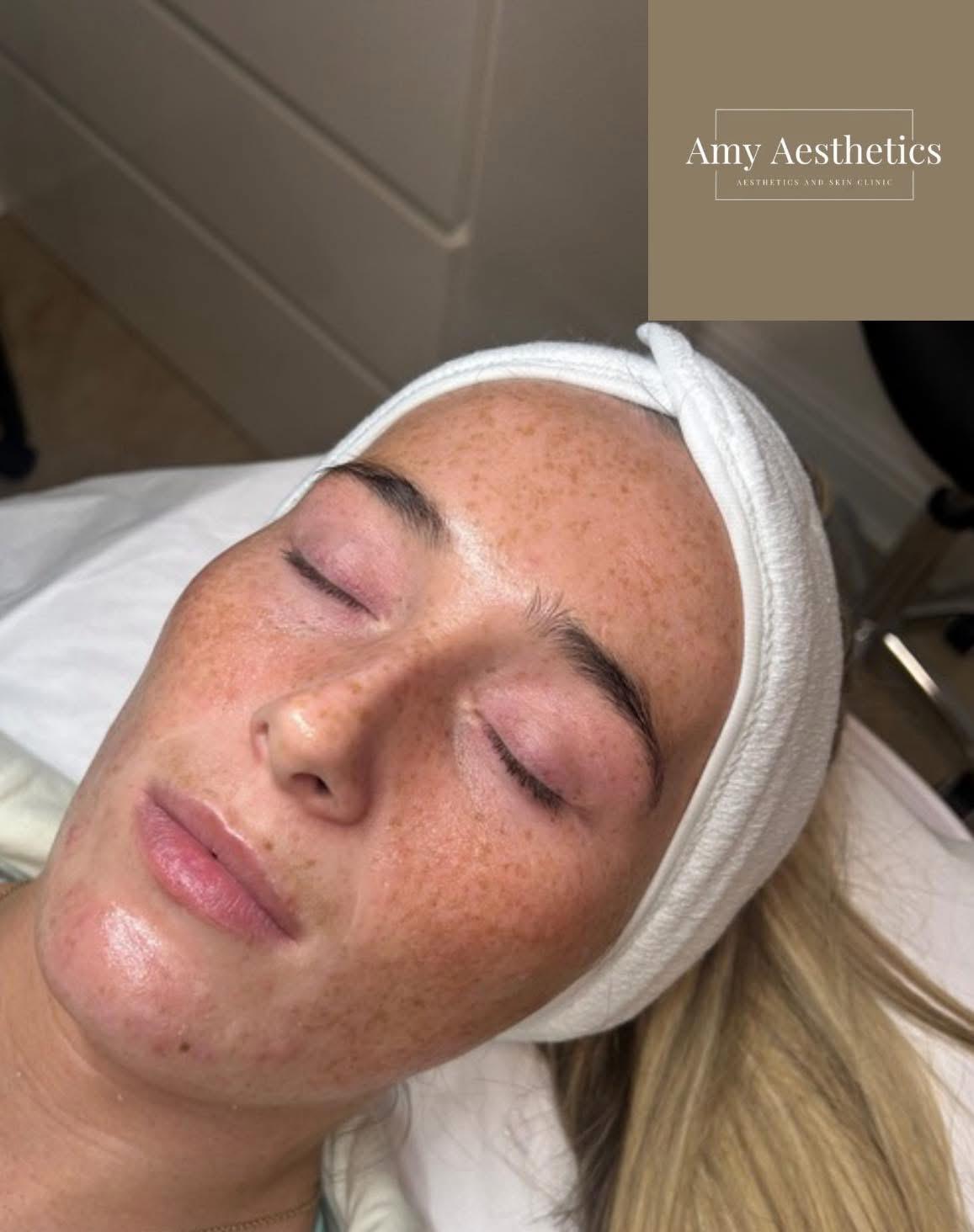 Dermaplaning Facial