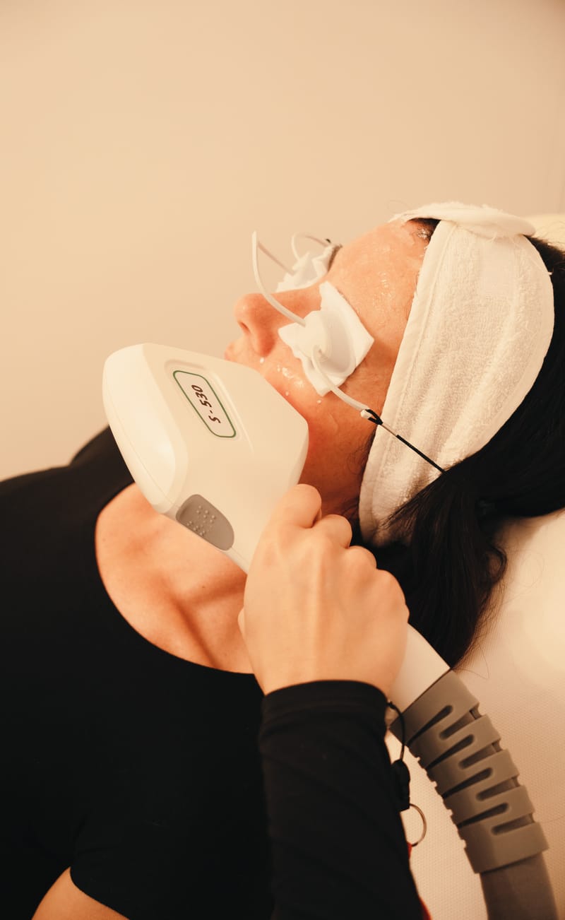 Traitement de l’acné - IPL 3D