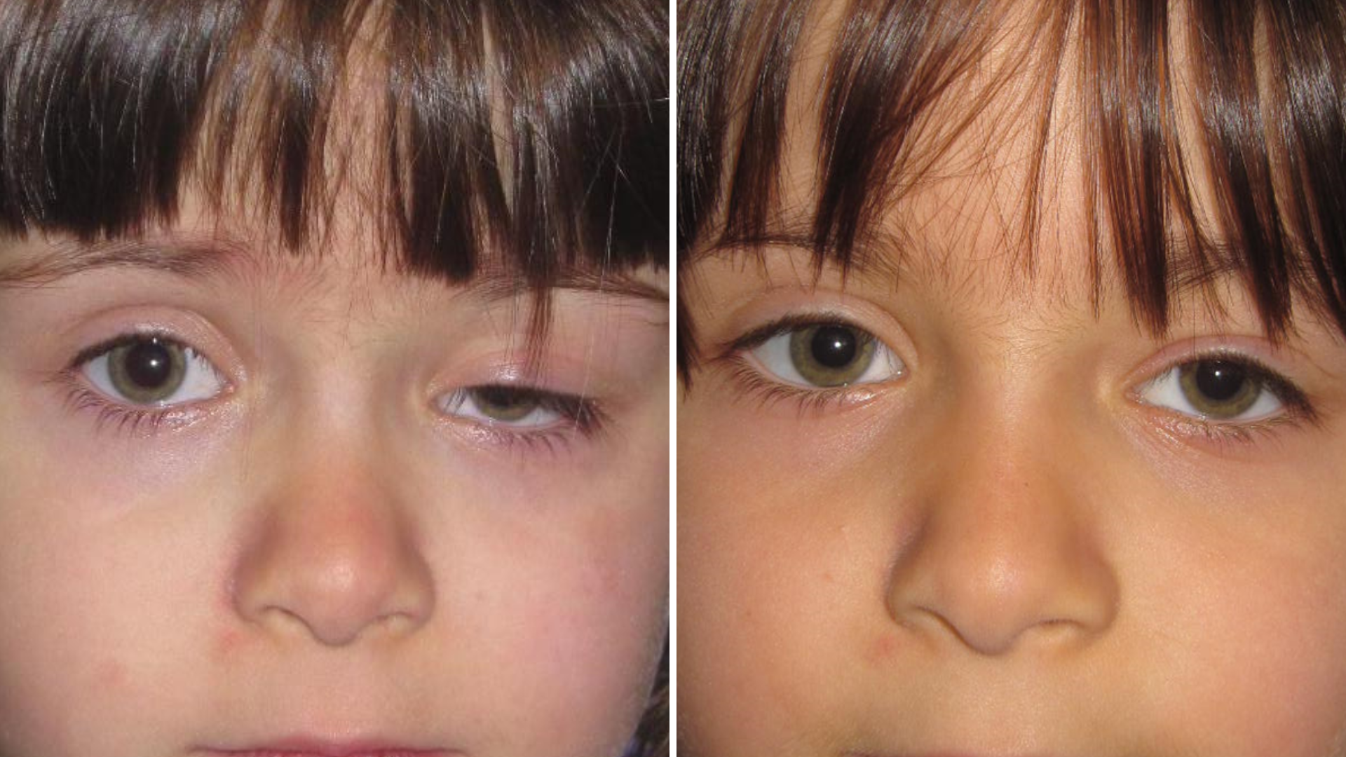 Ptosis en niños