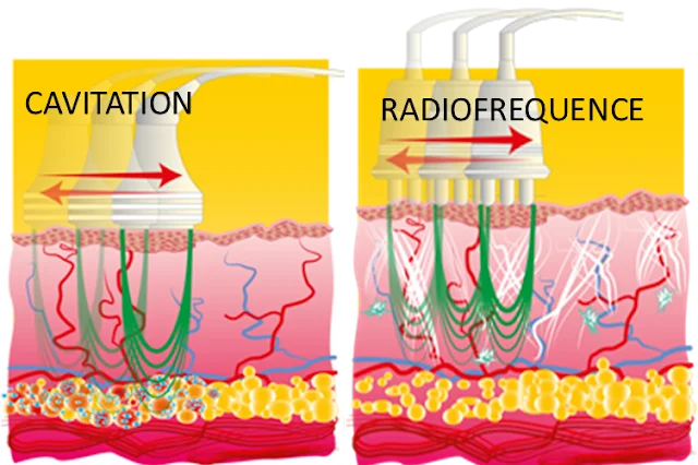 Massage Minceur (Lipocavitation - Radiofréquence - Vacuum)
