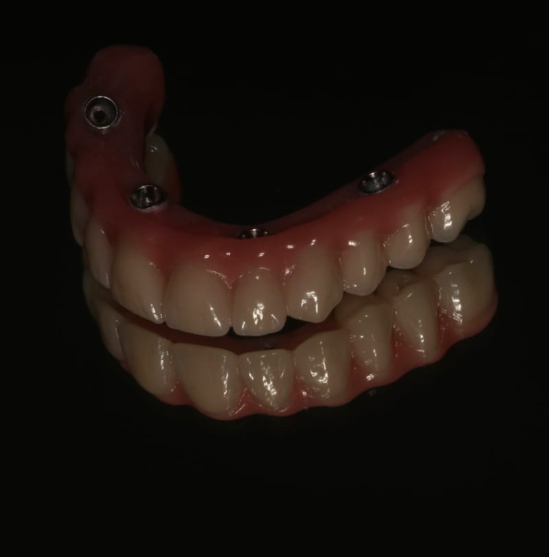 Protocolos sobre Implantes