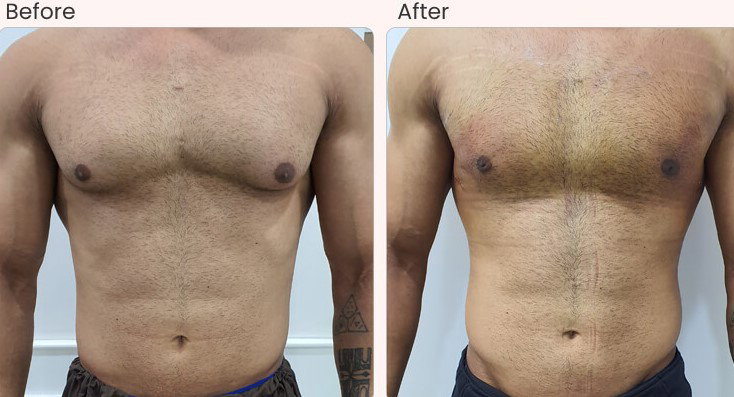 What Are the 5 Benefits of Male Breast Reduction?
