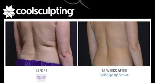 Body Contouring Fat Reduction Side Effects: What You Need to Know Before Treatment