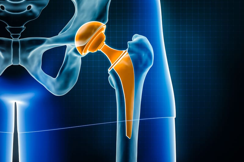 Joint Replacement