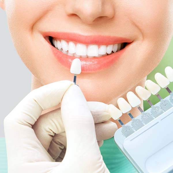 Dental Veneers