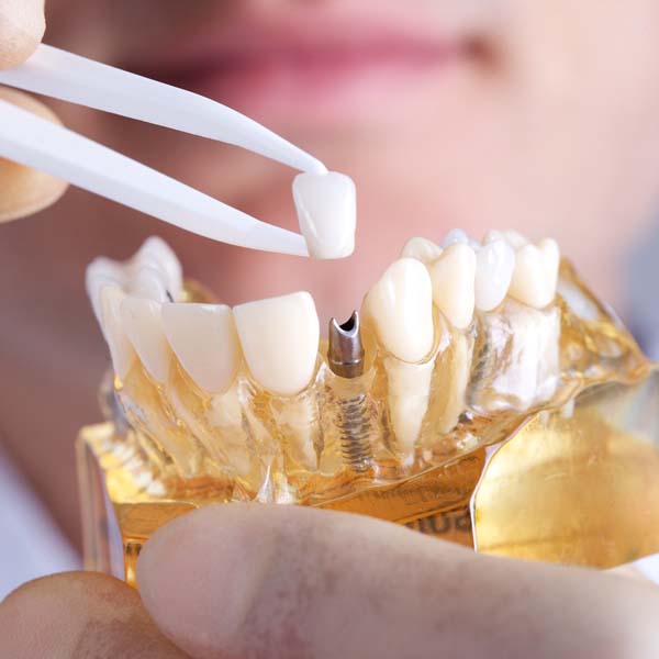 Dental Implants