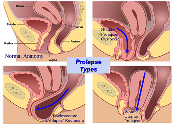 Pelvic Organ Prolapse Physiotherapy