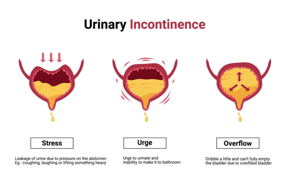 Urinary Incontinence in Women: Causes, Treatment, and How Physiotherapy Can Help
