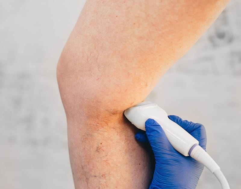 Skleroterapie pod ultrazvukem