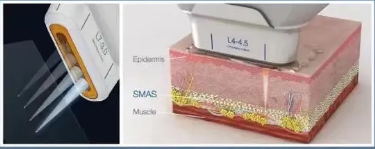 ✨ Rejuvenate Without Surgery: Why HIFU is Dubai’s Favorite Non-Invasive Facelift