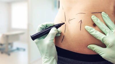 Laser Liposuction in Dubai – A Lifestyle Boost